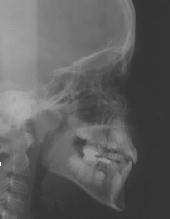 Fernröntgenseitenbild